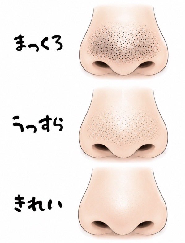 Qchan_biyou's tweet photo. こういういちご鼻の黒ずみには、

①レチノール
②グリシルグリシン
③ナイアシンアミド

の組み合わせがおすすめ

BHAで毛穴詰まり・角栓を除去→アゼライン酸で皮脂を抑えて黒ずみを予防→ナイアシンアミドで毛穴を引き締める。

「取る・防ぐ・引き締める」の3ステップでいちご鼻を根本からできる。 https://t.co/q4BRdXbxIA