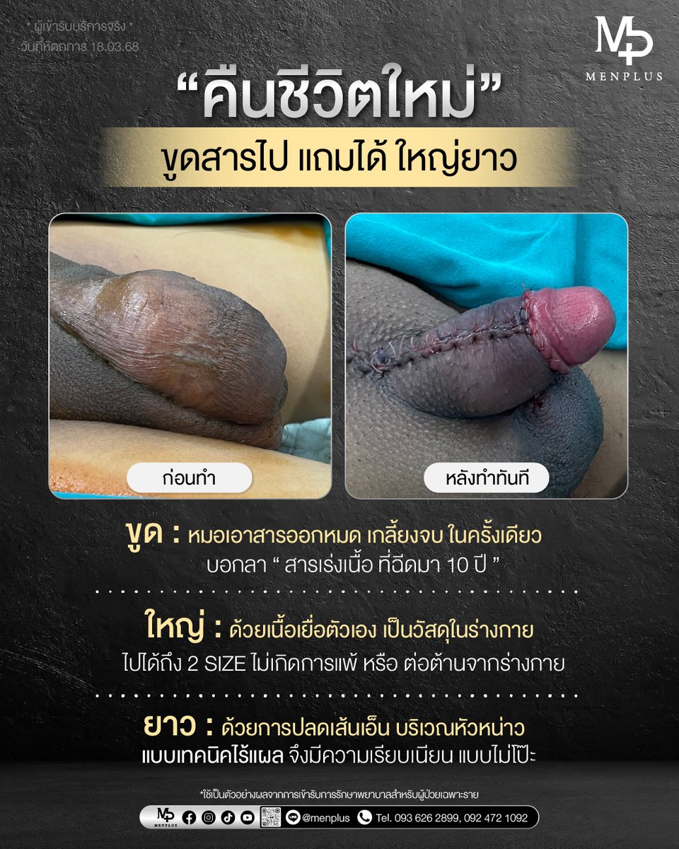 DrNutJirawee's tweet photo. ขูดสารไปได้ ใหญ่ยาว จริงดิ❓
#ขูดใหญ่ยาวกับหมอนัท
พร้อมคืนชีวิตใหม่ 😎 ให้น้องชายคุณ

" เปลี่ยนจริง ใหญ่จริง 💙 สวยจริง "

BY 👨🏻‍⚕️ นพ. จิรวีร์ จันทรานุกูล (ว.50941) เเพทย์เฉพาะทางยูโรวิทยา (Urologist) ศัลยแพทย์เฉพาะทางระบบทางเดินปัสสาวะ และ ระบบสืบพันธุ์

💡 #MenPlus #หมอนัทจิรวีร์ https://t.co/L3SQrQFA4Y