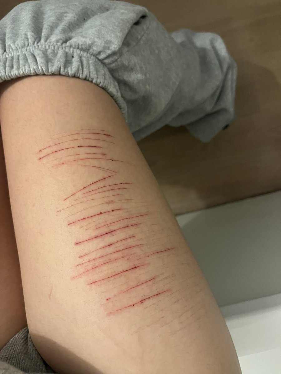 loomaaps's tweet photo. i miss when my scars were not that serious (old pic) #slittwt #shtwt https://t.co/Kgg0klXQly