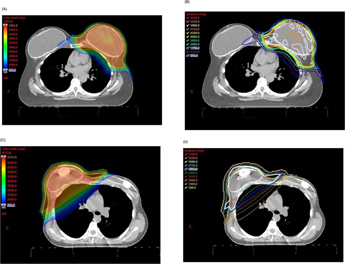 ASTRO_org's tweet photo. Optimization of skin dose as an OAR with IMPT yields low, comparable rates of radiation dermatitis relative to XRT for Post-Mastectomy Radiotherapy. Read about it in the #RedJournal. @KGergelisMD @MayoClinic @KimCorbinMD @dshumway @allisongardaMD https://t.co/aCJMG2OdgY https://t.co/2CE7av7N04