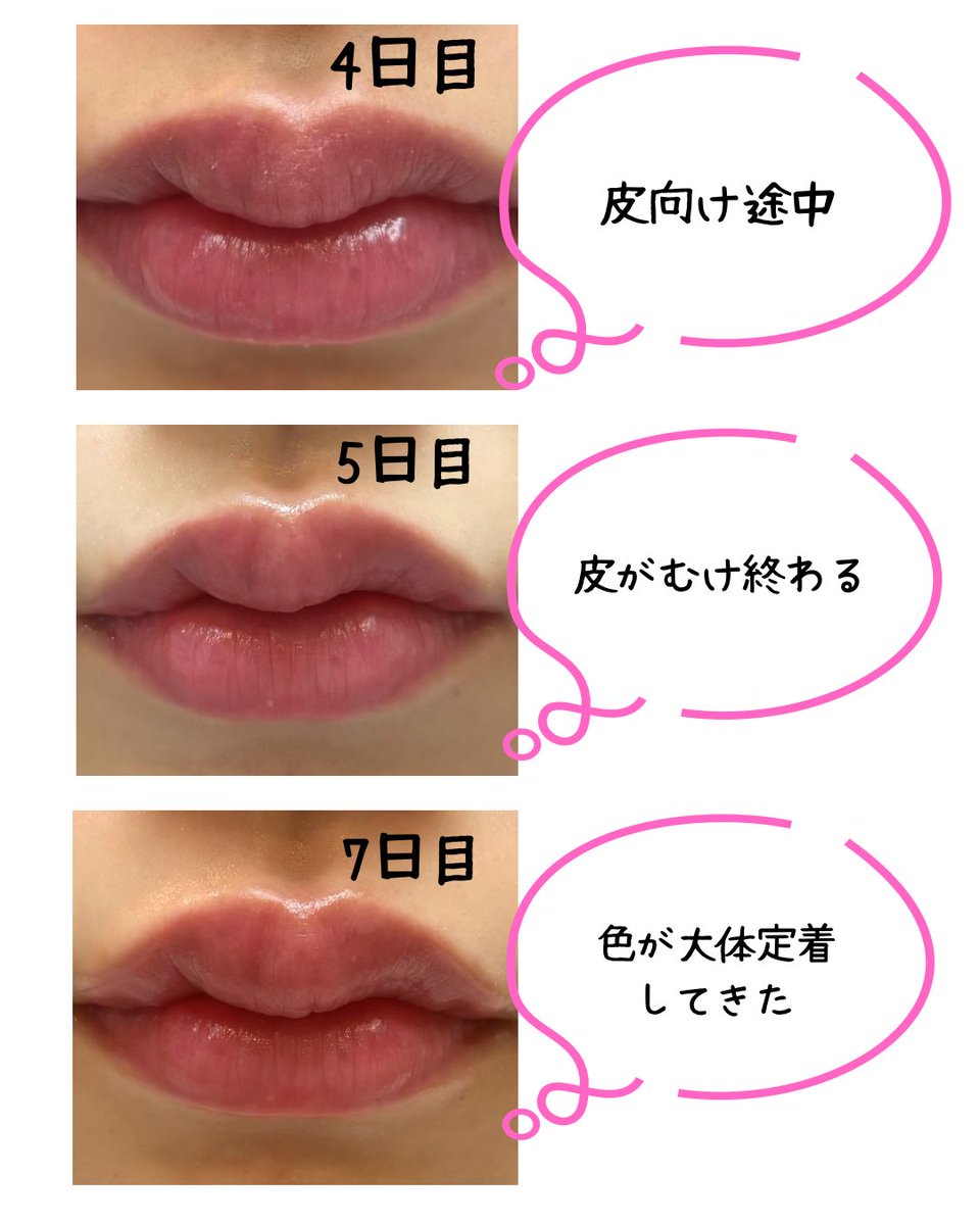 mon_77_mon's tweet photo. リップアートメイクの経過💋
今回は韓国江南にあるyomilでやってもらいました！
1週間ちょっと経ったけどまだ色残ってる🥺
思ったより全然痛くなくて、すっぴんでも唇に血色感ができて悩んでたけどやって満足🫶

@Yomil__artmake https://t.co/FEiAQdi9nU