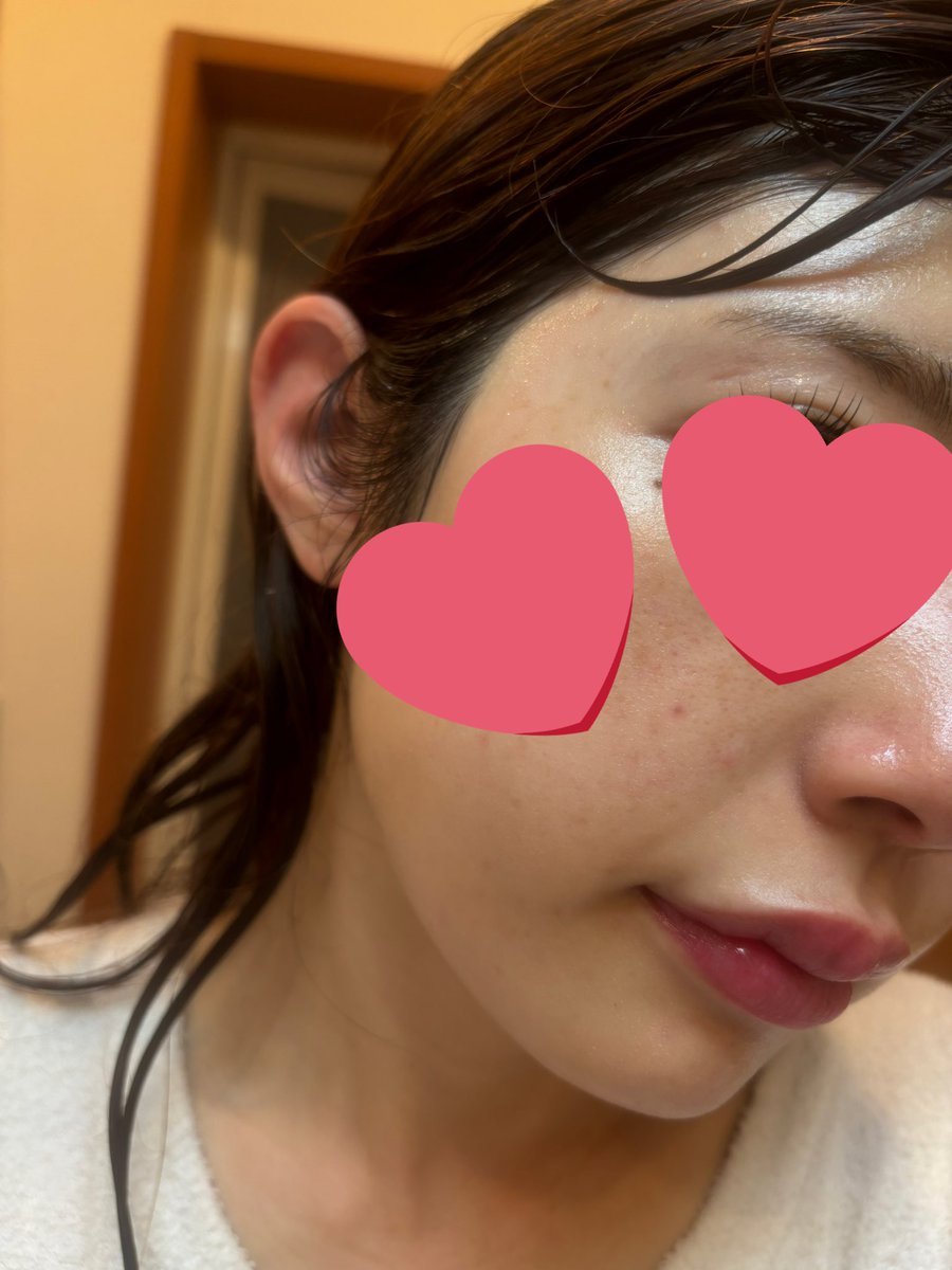 mon_77_mon's tweet photo. リップアートメイクの経過💋
今回は韓国江南にあるyomilでやってもらいました！
1週間ちょっと経ったけどまだ色残ってる🥺
思ったより全然痛くなくて、すっぴんでも唇に血色感ができて悩んでたけどやって満足🫶

@Yomil__artmake https://t.co/FEiAQdi9nU