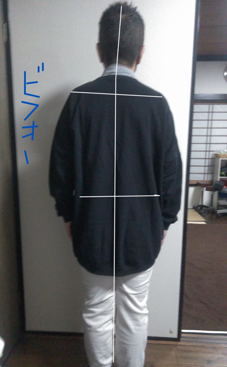aozorabs's tweet photo. 症例4(画像は初回の施術のビフォーアフター)
主訴は腰痛、歩行痛。ほかに右股関節拘縮。腰痛は体重が増えだしてから痛みが増してきた。対称の体に近づけて改善(#RESET)。(ほかに関節ファシアリリース、筋細胞リリース、神経筋整合法、セルフケアを含む https://t.co/rEMwV1Tukt