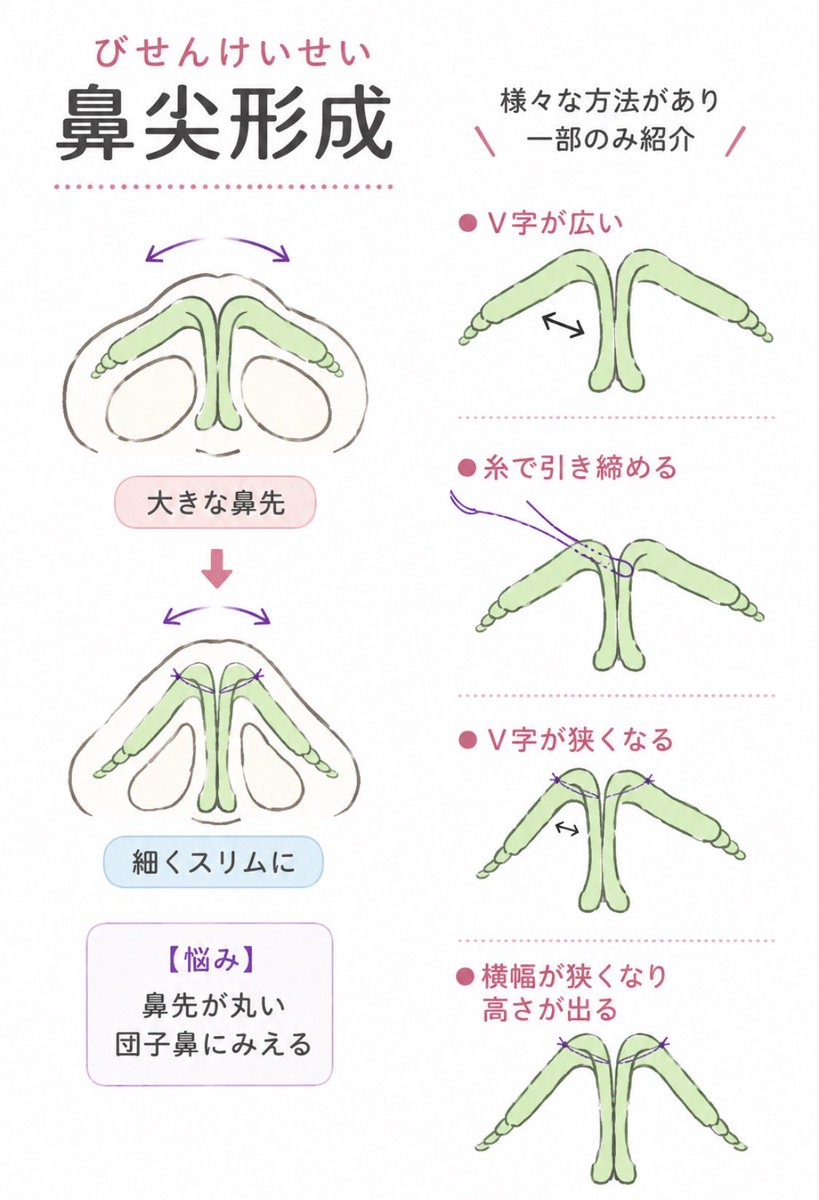 rin3ten's tweet photo. 鼻整形の基礎的な理解ができる図。

初心者の方は🔰プロテーゼ、鼻尖形成、鼻中隔延長、耳介軟骨移植とそれぞれ何をどうしてどうするのかはある程度視覚的に確認しておいてください。

理解するまでは鼻いじっちゃダメですよー🙅 https://t.co/2HoIGWMkcb