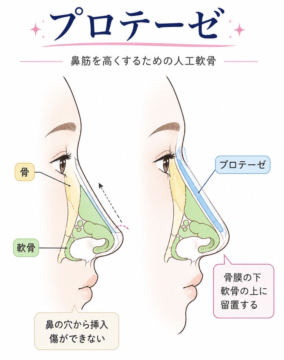 rin3ten's tweet photo. 鼻整形の基礎的な理解ができる図。

初心者の方は🔰プロテーゼ、鼻尖形成、鼻中隔延長、耳介軟骨移植とそれぞれ何をどうしてどうするのかはある程度視覚的に確認しておいてください。

理解するまでは鼻いじっちゃダメですよー🙅 https://t.co/2HoIGWMkcb