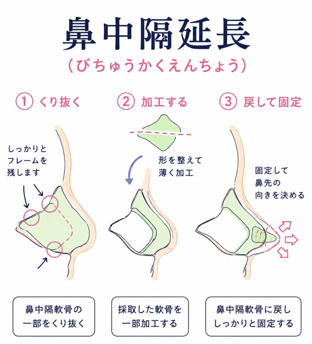 rin3ten's tweet photo. 鼻整形の基礎的な理解ができる図。

初心者の方は🔰プロテーゼ、鼻尖形成、鼻中隔延長、耳介軟骨移植とそれぞれ何をどうしてどうするのかはある程度視覚的に確認しておいてください。

理解するまでは鼻いじっちゃダメですよー🙅 https://t.co/2HoIGWMkcb