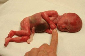 masvidaoficial's tweet photo. Bebé de 22 semanas sobreviviente de aborto. Cómo puede existir alguien que aún sostenga que el aborto no está mal? https://t.co/kMYX29vN4S