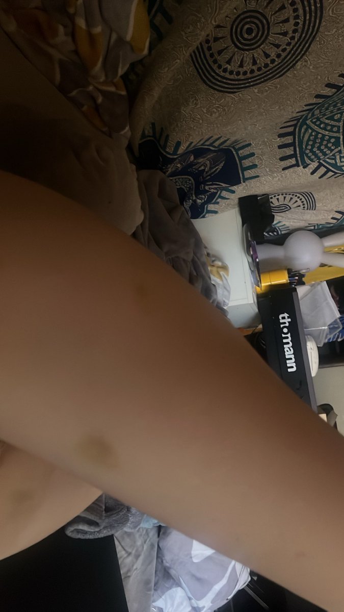 calypsem's tweet photo. jai jamais eu autant de bleus de ma vie frr mdrrr j'aime trop pcq qqn a laissé sa marque sur moi https://t.co/pi4cngsI5W