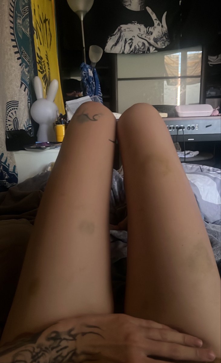 calypsem's tweet photo. jai jamais eu autant de bleus de ma vie frr mdrrr j'aime trop pcq qqn a laissé sa marque sur moi https://t.co/pi4cngsI5W