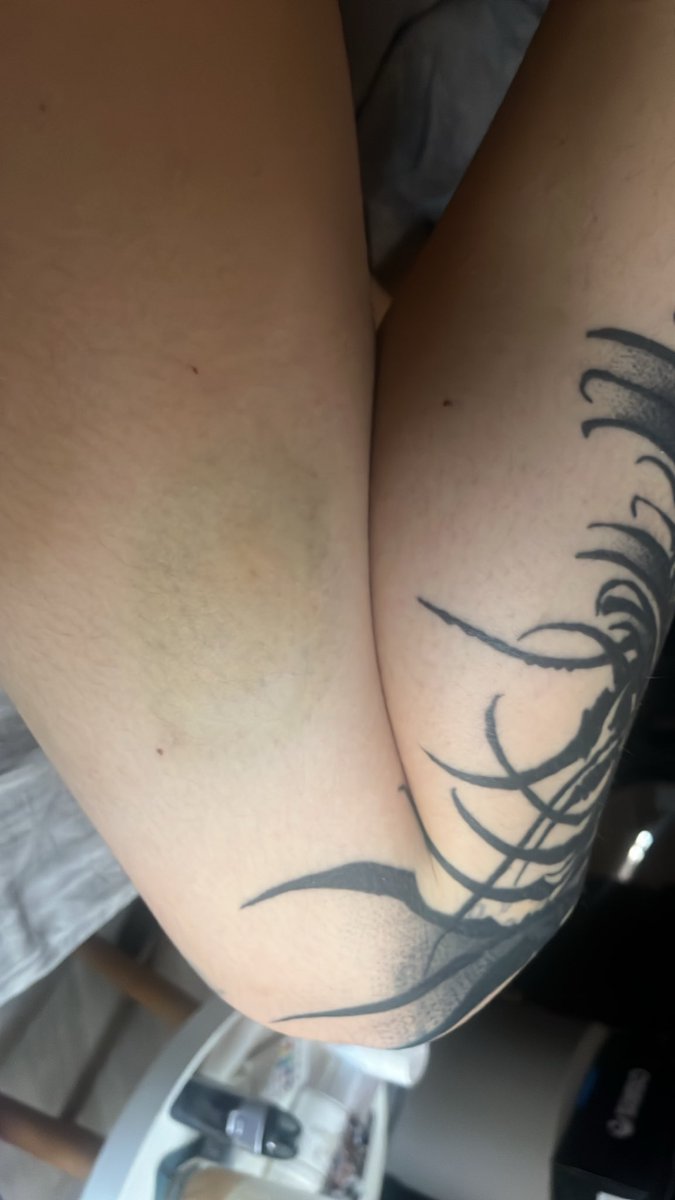 calypsem's tweet photo. jai jamais eu autant de bleus de ma vie frr mdrrr j'aime trop pcq qqn a laissé sa marque sur moi https://t.co/pi4cngsI5W