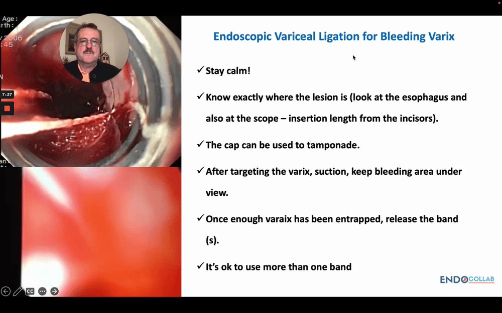 EndoCollabcom's tweet photo. Band ligation starts with targeting.
 
Identify high-risk stigmata, know the device, inspect the fundus, target the lesion, suction, release the band, then gently insufflate.
 
In active bleeding, keep the bleeding point in view. https://t.co/SzUlq4erJo