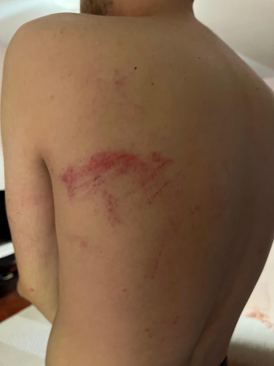 Asiavukatlarx's tweet photo. CHP İstanbul İl Başkanlığına yönelik 09/07/2026 tarihinde yapılan polis baskını sırasında orada bulunan ASİ Öğrenci Komisyonu üyemiz Ömer Faruk Aslan, polisler tarafından vücudunda morluklar oluşacak şekilde darp edilmiştir. Kolluk görevlilerinin üyemize yönelik bu fiilleri, Türk Ceza Kanunu’nda düzenlenen işkence suçunu oluşturmaktadır. Unutulmasın ki bu suçta zamanaşımı hükümleri uygulanmaz! 

Üyemizin yanında, hukuksuzlukların karşısındayız!

Avukatın Sesi İnisiyatifi