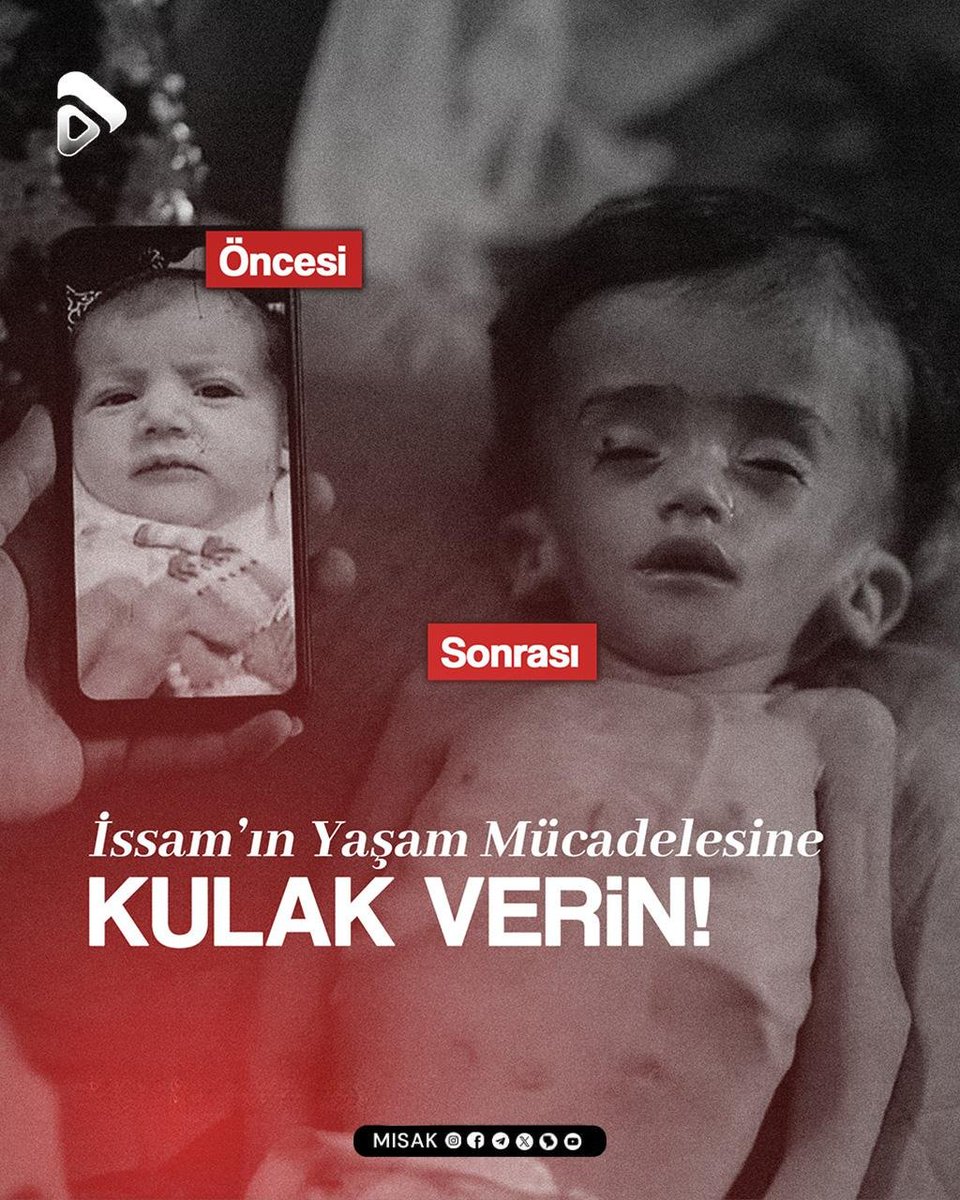 misak_tr's tweet photo. 🔰ZAMAN DARALIYOR! İssam'ın Sesi Olun...

Gözlerindeki o masum bakışın değişmemesi için şimdi destek zamanı. 1 yıl 3 aylık İssam bebek, "Serebral Hidrosefali" hastalığına karşı çok ağır bir mücadele veriyor.

#AKSA_TUFANI

#Güner
#AhmetTelli
#cumartesi

#MISAK https://t.co/czQcOQeHgI