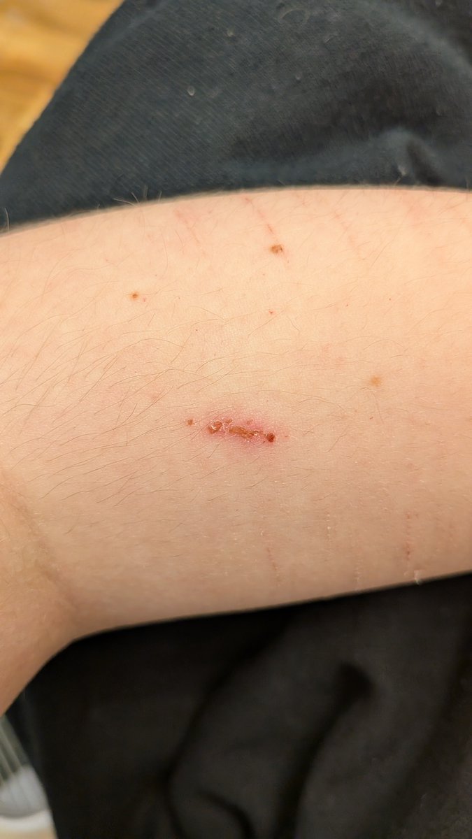 drewbloxx's tweet photo. eraser burn still wont fade oh my god bro https://t.co/ySsOpOe36g