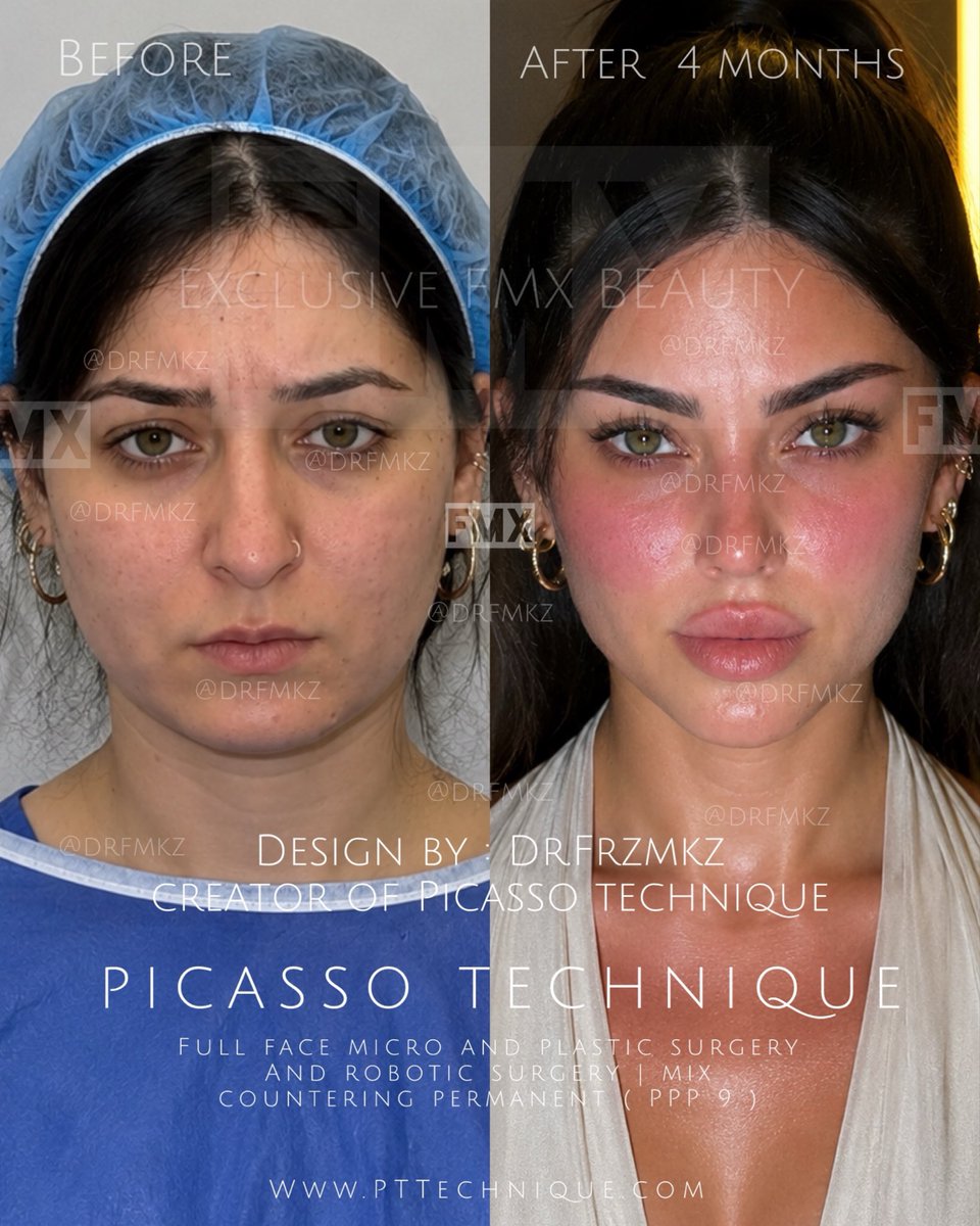frzmkz's tweet photo. Some transformations aren’t about becoming someone else.
They’re about revealing the version that was always there.
Day 1 → Month 4.
What do you notice first?
#PicassoTechnique #FacialTransformation #BeforeAndAfter #fmxlongevity #drfarzanmalekzadeh https://t.co/pVRnJRsq3V