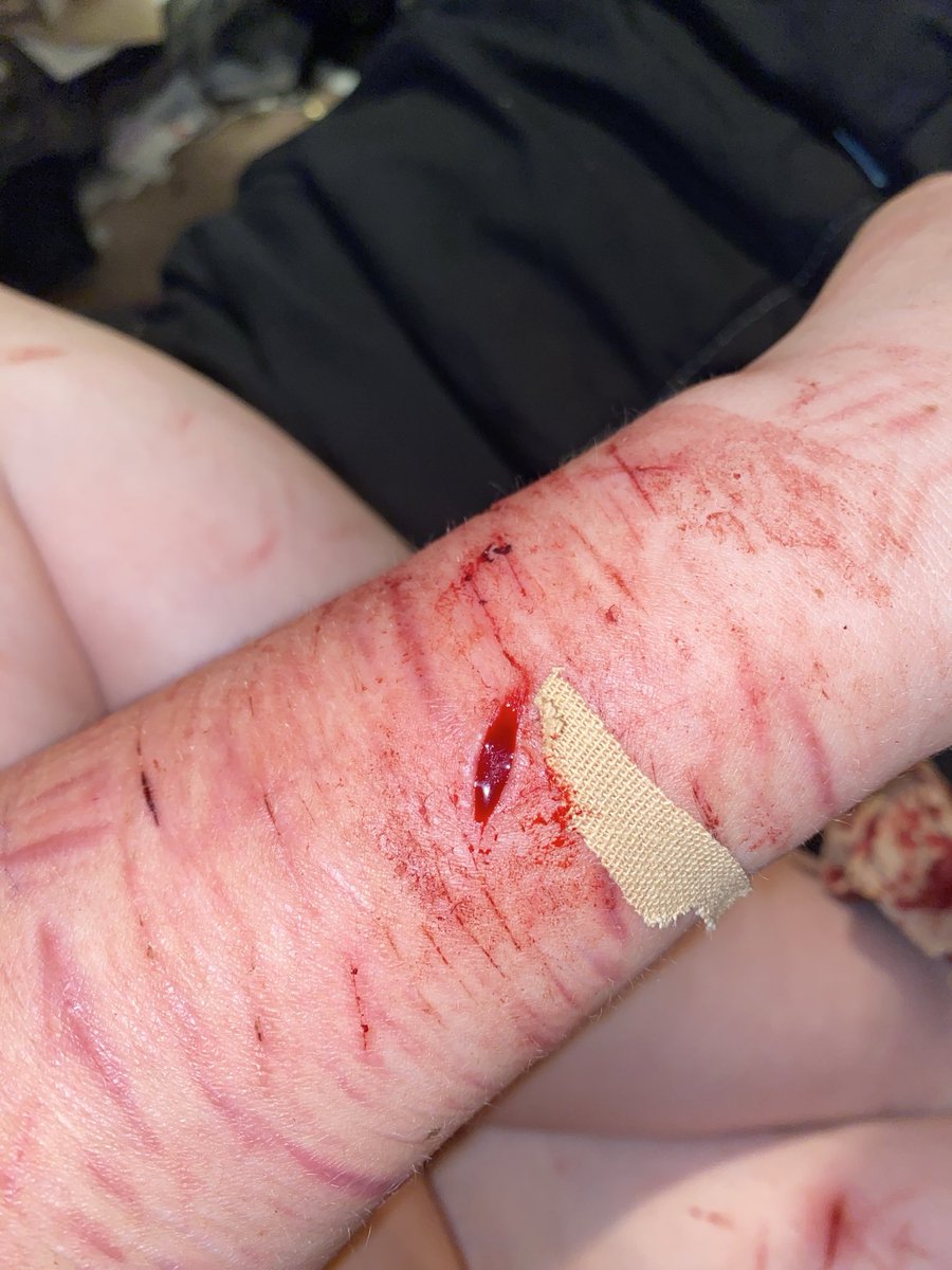 PsychoBixches's tweet photo. Fake body SFX makeup
This got deleted so hete is is again it’s not real Twitter it’s ai generated
#sh #shedtwt #slittwt #babybeans #beanstwt #988twt #selfharm https://t.co/eOaOYx1K9x