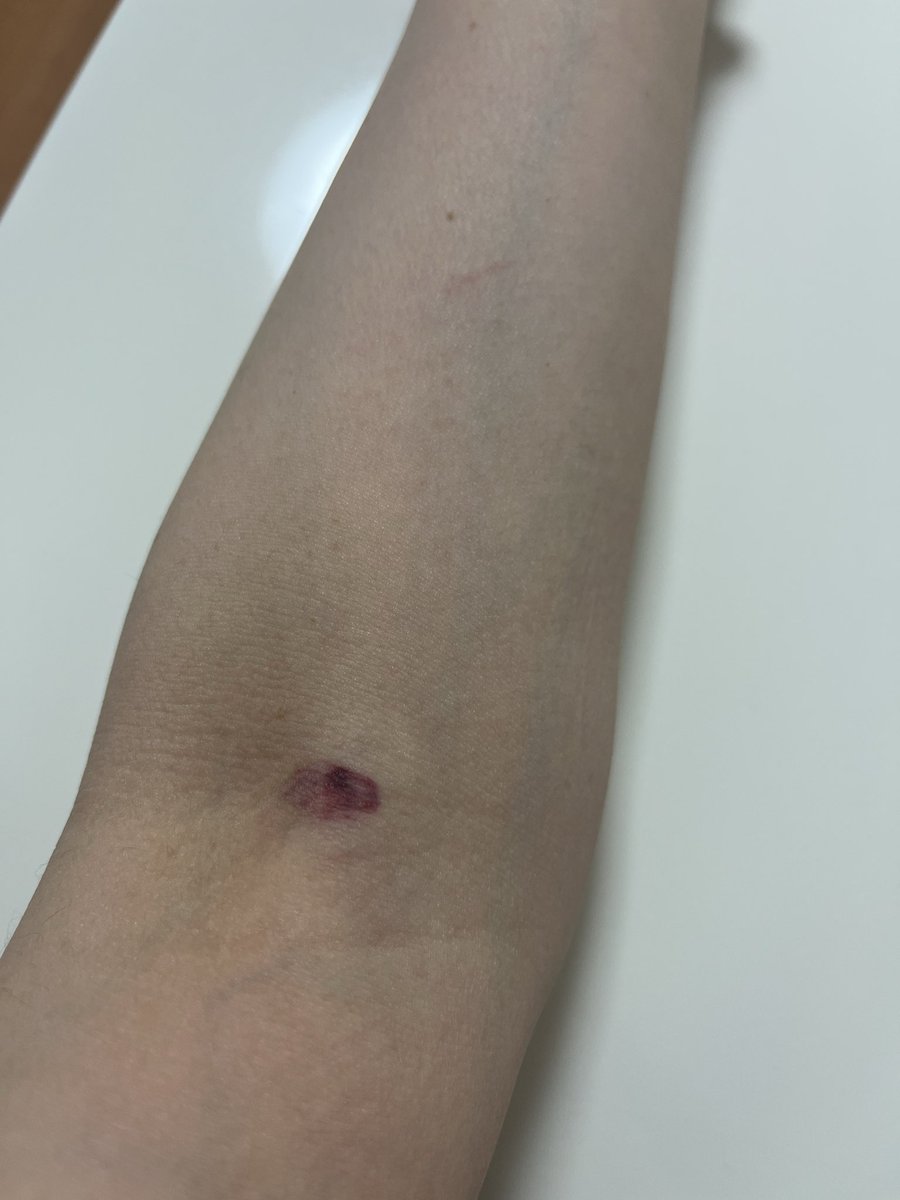 ciel0832's tweet photo. 今日の健康診断で、コレ付けてくれてたw
迷走神経反射だから採血は横になってするんだけど、途中で「血が止まってしまいました」って言われて気持ち悪くなってきた
結局両腕から取られて今コレ
見ると気持ち悪くなるからバンドエイド貼る https://t.co/FYG1fUDL64