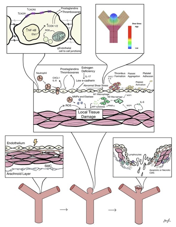 DrKNowicki's tweet photo. In this fun thought paper we review the challenges associated with development of a blood test for cerebral aneurysm detection, and provide the rational assumptions and pathway to turn such translational efforts into reality. 
https://t.co/ee01P88xrs https://t.co/QR8y0GU2ir