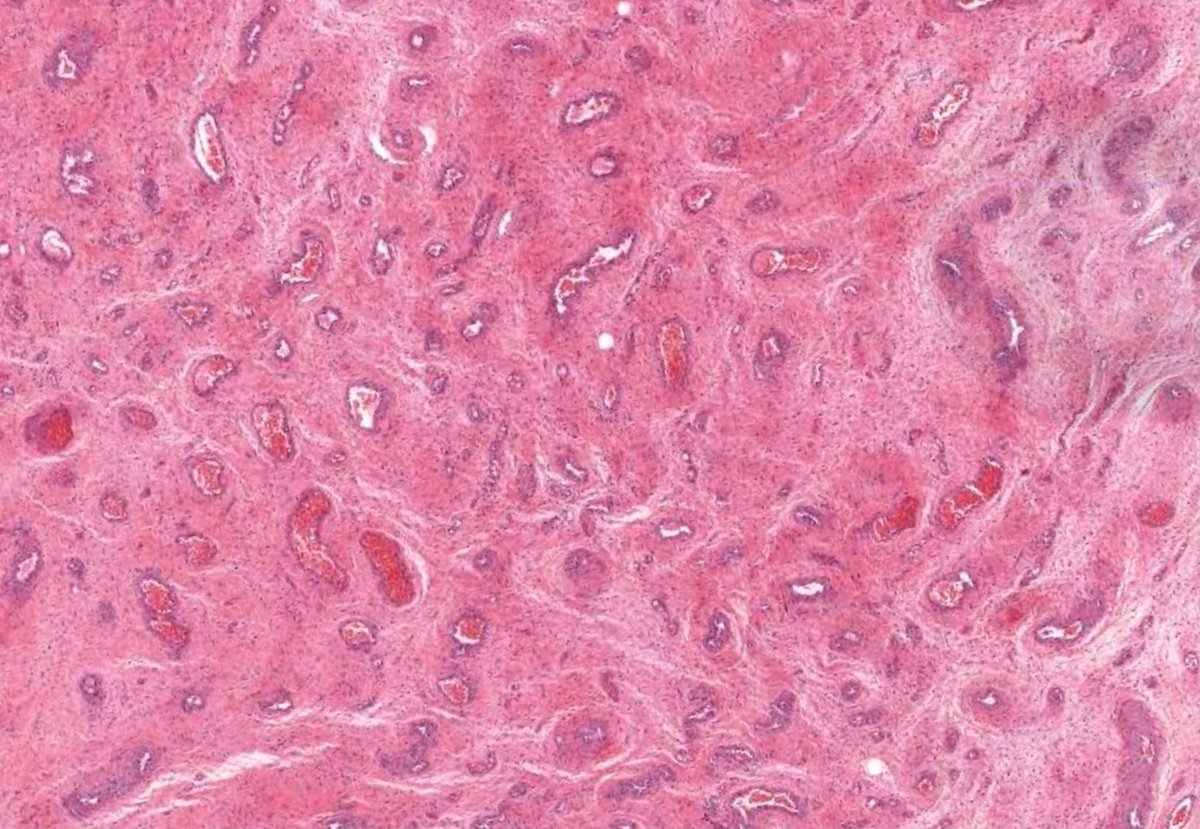 JMGardnerMD's tweet photo. 35 yo woman with vulvar mass. 15cm & infiltrative on CT.
digital slide: https://t.co/s9GDKrNZYe.
Answer ✅ https://t.co/23V32QVtNb
#pathology #BSTpath #pathologists #pathTwitter #gynpath #dermpath https://t.co/fABy5DdiVp