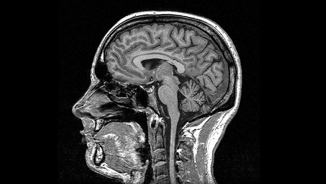 Outdoctrination's tweet photo. Thiamine (vitamin B1) has powerful protective effects for the brain, reducing death from severe brain injury by >50% in multiple studies.

One study came out in 2024 in Frontiers in Nutrition.

They examined people with traumatic brain injury who got thiamine treatment or those who didn't.

It wasn't an experiment - it was an associational study, but the design makes it pretty strong.

They did propensity score matching (PSM).

Essentially, this helps remove confounding variables by only including people who could be matched up with a similar "control" who did not receive the thiamine.

This ensured that the 402 people and their non-thiamine matches were similar in all measures so that any effect was attributable to thiamine.

Thiamine led to a reduction in mortality of around 55%.

16.2% of people in the non-thiamine group died vs 7.2% in the thiamine group.

They did stay a bit longer in the hospital by a few days, a small price to pay for staying alive.

On average, people took around 200 mg of thiamine IV.

After matching, this is what the survival rates looked like.

374 people on thiamine survived.

337 people died without it.

~37 people were saved by thiamine (assuming no other confounders).

200 mg of thiamine costs like 5 cents.

What's amazing is that with higher amounts of thiamine the results were even better.

People getting >200 mg of thiamine during their hospital stay had their risk of death slashed by over 2/3rds.

Incredible.

This was not a one off study either.

This study from 2025 showed similar results.

A ~65% reduction in death from traumatic brain injury simply by administering thiamine.

Why is thiamine so helpful for the brain?

Higher thiamine levels are protective against negative outcomes from brain injury and even cognitive decline.

Even blood levels cannot rule out a need for more thiamien as discussed below:

Thiamine is critically important in the brain for multiple reasons:

1. It is a cofactor for multiple enzymes in mitochondrial energy production. Without enough thiamine, you don't produce enough energy, which is required for repair of all of the structures within the brain.

One thiamine dependent enzyme (aKGDH) is a primary target of traumatic brain injury - it's activity becomes severely depleted. Adding thiamine in helps.

2. It prevents lactic acid production. Because thiamine is a cofactor for pyruvate dehydrogenase (PDH), it diverts glucose metabolism towards energy and away from lactic acid.

Lactic acid promotes inflammation in multiple cell types - including the microglia in the brain. The resulting acidity also can promote inflammatory responses.

Inflammation in the brain is a driver of brain injury, but also is heavily involved in things like depression and even brain fog and fatigue.

Being low functionally on thiamine sets you up for all of this.