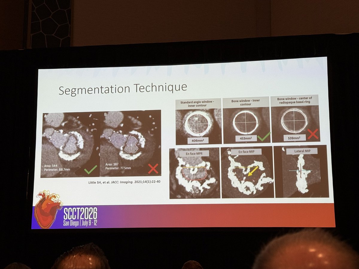 iamritu's tweet photo. @ASE360  @Heart_SCCT 
SHD intervention planning @OKhaliqueMD @AkhilNarangMD chairs
What to do w MAC pre TMVR? 
#Yessct is 🔑 
MAC complicates segmentation (more difficult) CT helps predict fluoroscopic angles to ⬇️procedure time https://t.co/Zg502Qf0Wk