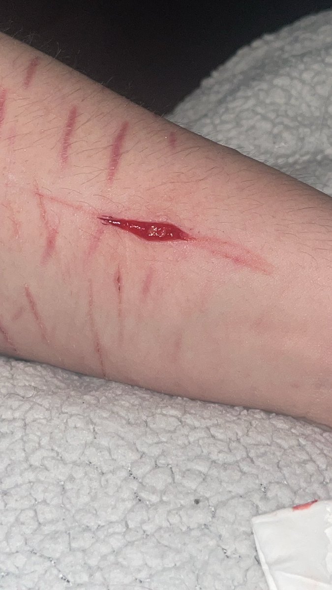 Strawberry_Cuts's tweet photo. Before and after! This scarred nice 🥹 it was in a bad spot though, hurt like hell. https://t.co/HiN3giutY5