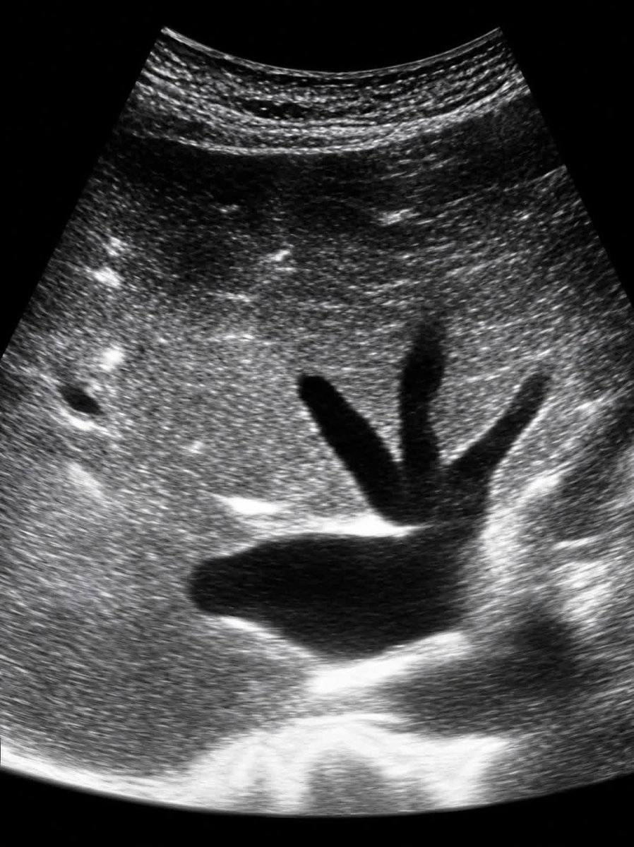 hemo_shk's tweet photo. An unusual ultrasound pattern.

What is the diagnosis and the sonographic sign? https://t.co/1J8jy0aNk1