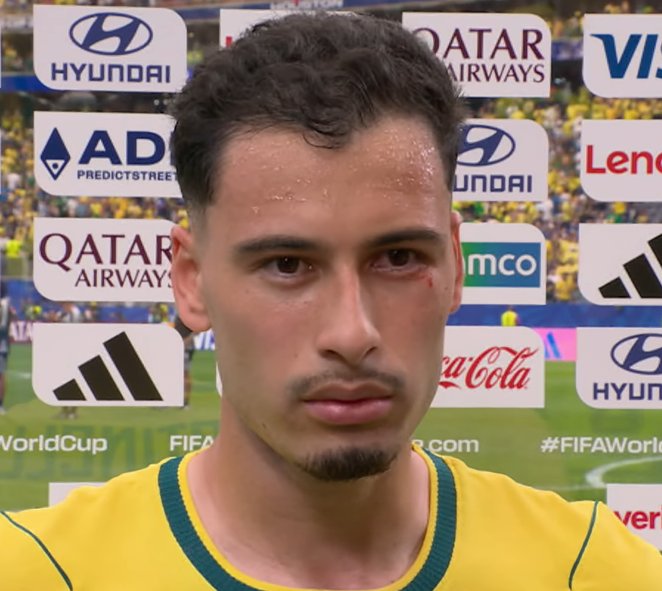 ilyjawreguis's tweet photo. como pode o gabriel martinelli entregar face card com o rostinho todo fudido isso não existe https://t.co/lZdJiVw35P