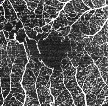 RetinaSociety's tweet photo. Enlarged foveal avascular zone with telangiectatic vascular remodeling in a 38 year old with type 1 diabetes mellitus, complicated by proliferative diabetic retinopathy. https://t.co/BhGz4QR55j