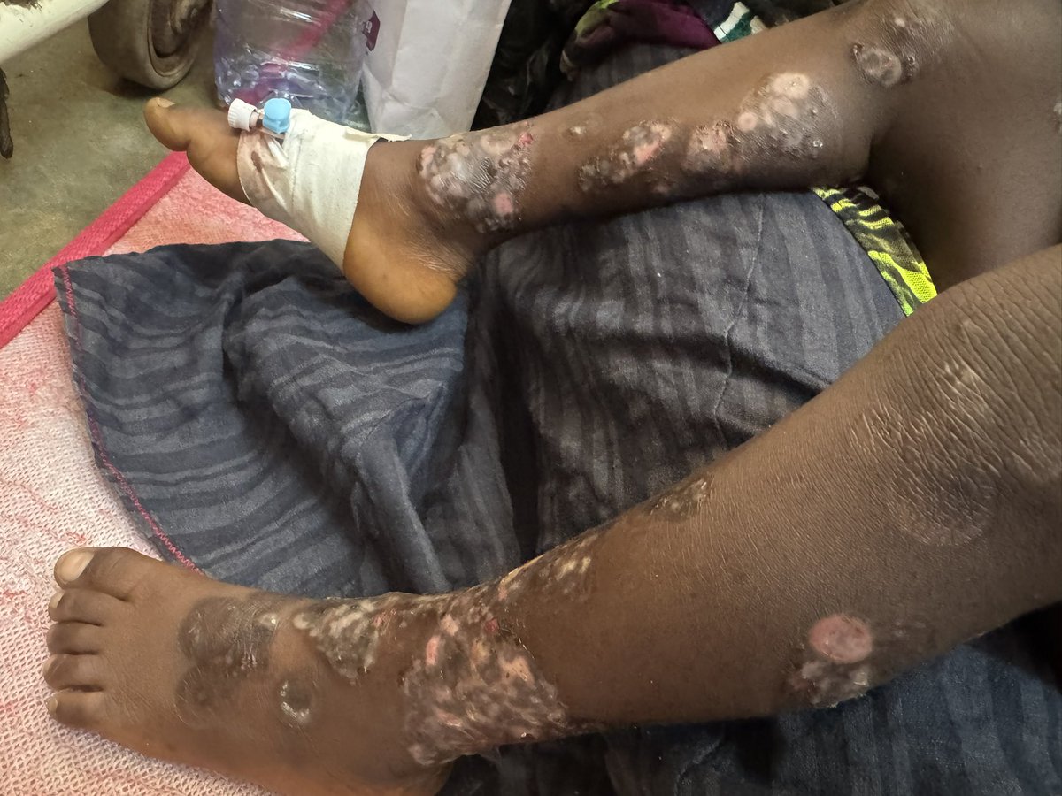 SabrinaKitaka's tweet photo. A 3 year old presented to us with bullous lesions on limbs and trunk sparing the face &amp; mucosa.
What is your likely diagnosis? https://t.co/40AMBv61b4