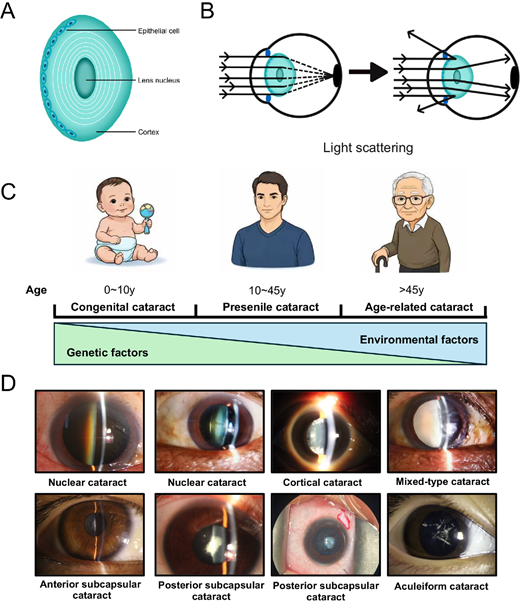 ARVOiovs's tweet photo. Review article by Haoan Yi, Xu Zha et l. from Kunming Medical University discussed human crystallin variation and its implications for cataracts. 
https://t.co/A1fj8nCt4N https://t.co/q6gJhwQDvm