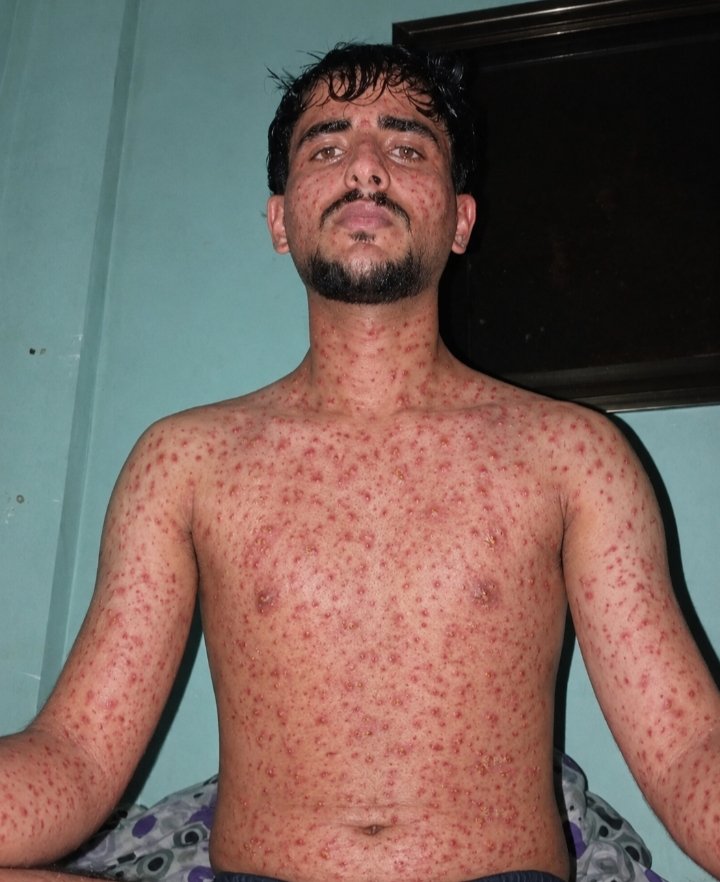 fares_khalil_20's tweet photo. The difference between the two photos shows the result of living in a tent amidst venomous insects. I need medical treatment, but in Gaza, treatment is difficult to obtain without money—and I have no funds for it. Please, help me.https://t.co/V6fbJnDlrF https://t.co/0admYpBnKB