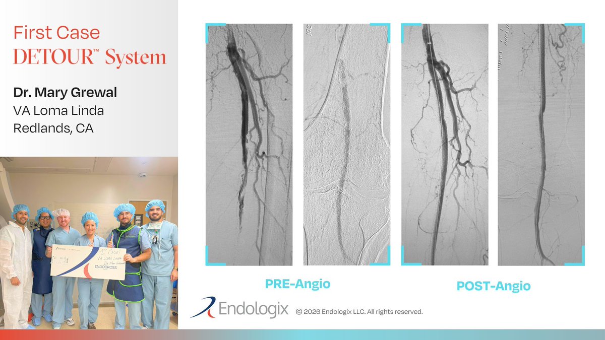 endologix's tweet photo. Another excellent first #DETOURSystem case, this time for Dr. Mary Grewal at VA Loma Linda. We applaud you for advancing treatment for our honorable veterans with complex SFA disease in need of durable, minimally invasive revascularization. 

Learn about restoring flow with the #DETOURSystem: https://t.co/ycFuGmcK9i

@valomalinda #PTAB #endovascular #healthcareinnovation #cardiotwitter #endovascularinnovation #medicalinnovation