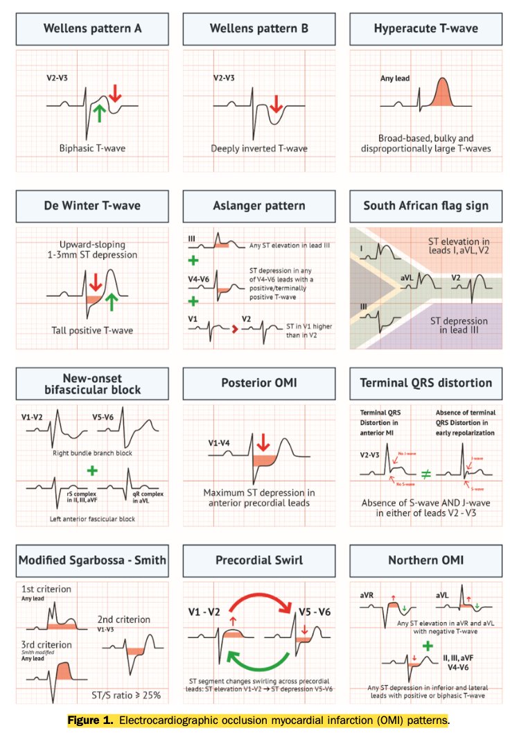 LuisOliverio's tweet photo. Hace poco vi un paciente con infarto agudo de miocardio con elevación del ST (IAMcEST) así que... le di una buena repasada. A llevarse: 

🔵 El ECG manda pero a veces miente. Toma el ECG en ≤10 min y  si tiene criterios-contexto clínico: reperfusión - aún sin esperar troponina.
🔵 No toda oclusión eleva el ST. Reconoce los equivalentes: De Winter, Wellens, posterior (V7-V9), T hiperagudas. Con bloqueo de rama, Sgarbossa modificada de Smith ≥3 puntos = 91% sens / 90% esp.
🔵Tiempos para recordar: ICP primaria ≤90 min (≤120 si traslado); si la ICP se tardará >120 min: fibrinólisis (idealmente a las <12 h de síntomas).
🔵 REBOOT Trial 2025 (NEJM): el beta-bloqueador post-infarto con FEVI >40% no aporta beneficio. Resérvalo para disfunción ventricular.
🔵 Cada vez más evidencia para doble antiagregación por poco tiempo (1 mes parece suficiente - TARGET-FIRST Trial (NEJM 2025) y Meta-análisis, Fujii T. Heart. 2026)
🔵 En monoterapia de por vida, clopidogrel es superior a Aspirina (SMART-CHOICE 3 Trial - Lancet 2025)
🔵Revascularización completa… salvo en choque. En multivaso estable reduce eventos; en choque cardiogénico, solo el vaso culpable (CULPRIT-SHOCK). Y oxígeno únicamente si SpO₂ <90%.

Nada más porque se puede, aquí la lista de todos los estudios revisados, están todos y cada uno actualizados en el tema de Accio (https://t.co/PSaT85OmNI) con su algoritmo interactivo.

CLARITY-TIMI 28, COMMIT, TRITON-TIMI 38, PLATO, CHAMPION PHOENIX, BRIGHT-4, ATOLL, ExTRACT-TIMI 25, OASIS-5, OASIS-6, REBOOT, EPHESUS, VALIANT, SHOCK, FITT-STEMI, STREAM, REACT, PRAMI, COMPLETE, BIOVASC, MULTISTARS AMI, CULPRIT-SHOCK, OAT, DECOPI, DanGer-SHOCK, IABP-SHOCK II, ECLS-SHOCK, ECMO-CS, MADIT II, DINAMIT, VEST, IMPROVE-IT, FOURIER, ODYSSEY OUTCOMES, CLEAR Outcomes, AVOID, DETO2X-AMI, TARGET-FIRST, TWILIGHT, STOPDAPT-2 ACS, MASTER DAPT, HOST-EXAM, SMART-CHOICE 3, OPTION, COLCOT, LoDoCo2, LoDoCo, COPS, CONVINCE, CLEAR-SYNERGY y FLUVACS.