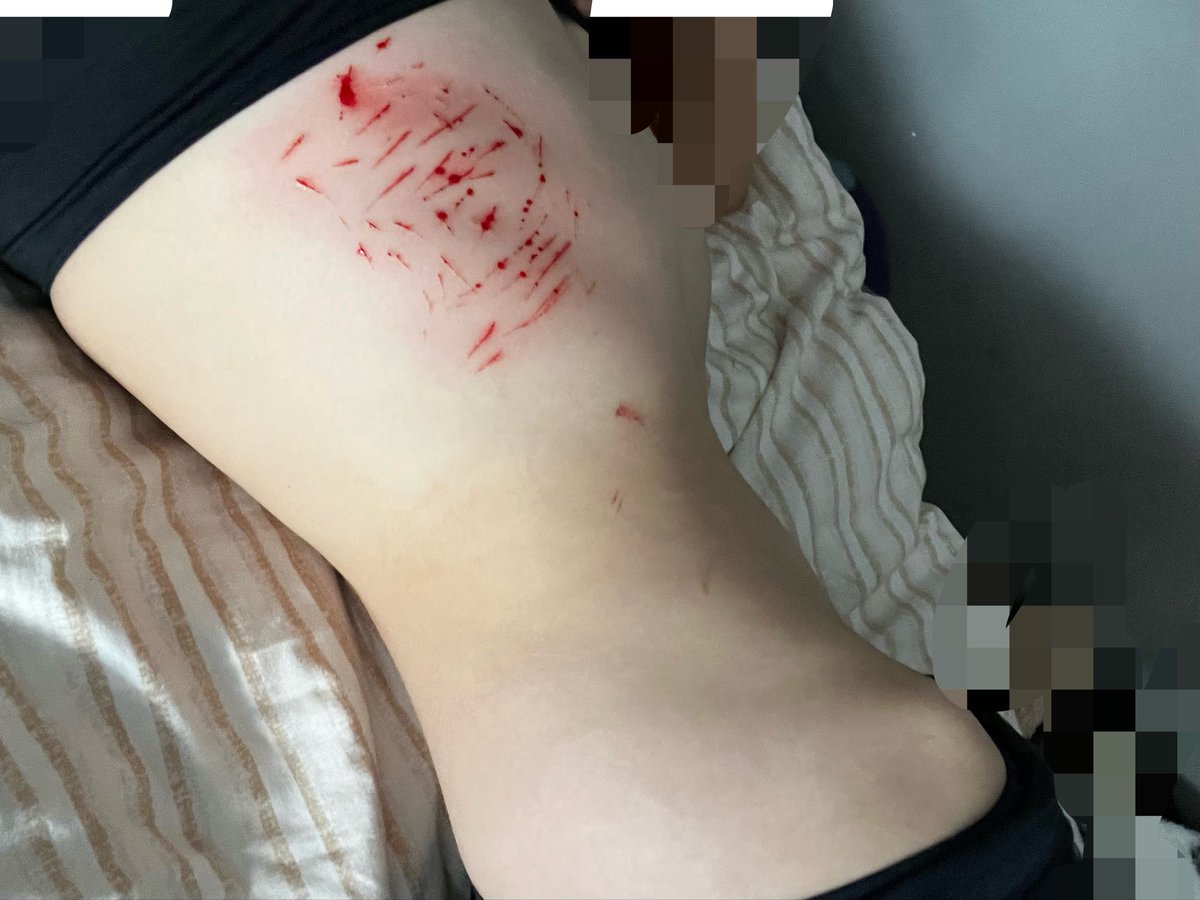 michelleshtwt's tweet photo. cat scratches + baby styros on my ribs !! might switch to this location now it’s really good // the last image is really shit ignore that // #shtwt #shedtwt #slittwt #cuts https://t.co/pvxNqsGdNH