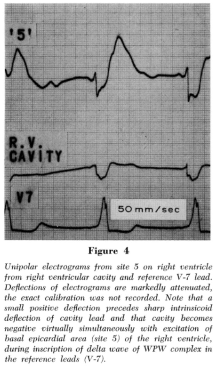 IkramHaqMD's tweet photo. #HistoryOfEP The 1st AP mapped in a human was a right lateral AP in 1967

Drs. Burchell, Frye, Anderson &amp; McGoon @MayoClinic surgically mapped the epicardium found the earliest V activation -> injected lidocaine -> pre-excitation disappeared 

PMID: 6050924 https://t.co/MK4kIzJCFy