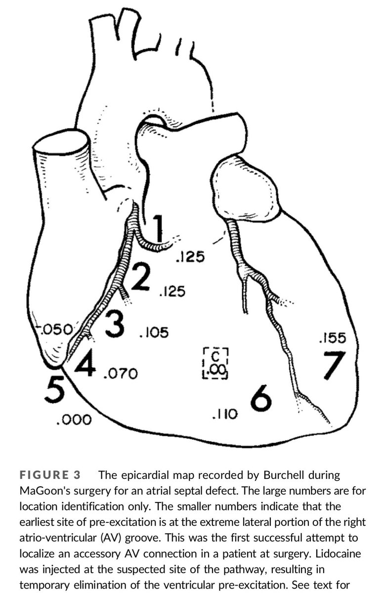 IkramHaqMD's tweet photo. #HistoryOfEP The 1st AP mapped in a human was a right lateral AP in 1967

Drs. Burchell, Frye, Anderson &amp; McGoon @MayoClinic surgically mapped the epicardium found the earliest V activation -> injected lidocaine -> pre-excitation disappeared 

PMID: 6050924 https://t.co/MK4kIzJCFy