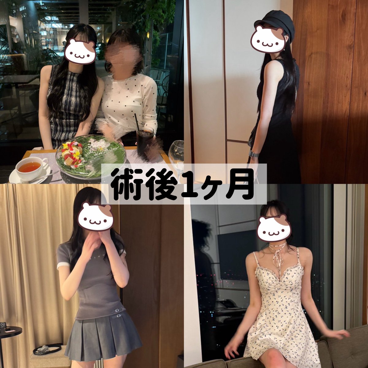 tem_lew0405's tweet photo. 二の腕、副乳、脇裏の脂肪吸引から約1ヶ月以上が経ちました✨

術前と比較すると本当にやってよかった😭😭
自分に自信が持てるようになって、
着たいお洋服が増えて幸せ👗🎀

#二の腕脂肪吸引　#整形垢と繋がりたい #整形垢 https://t.co/CtQzQhuKmM