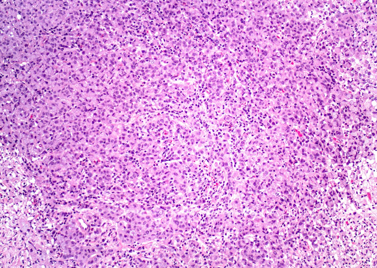 GuannanTiffany's tweet photo. 🧩 Bladder riddle
Sheets of cells with this classic morphology.
The patient’s gender matters.
What are your working diagnoses?
#DxMindMap #BladderPath #GUPath #Mimicker #PathTwitter @JHUpath https://t.co/fHSBdN0Gk7