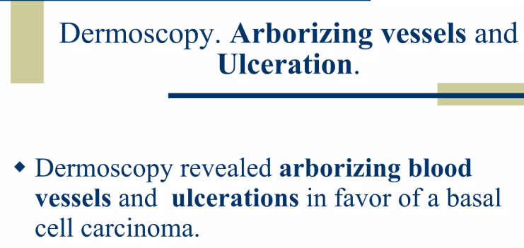 Aborizing Pattern Basal cell carcinoma. - Branched/arborizing vessels - Ovoid nests ...
