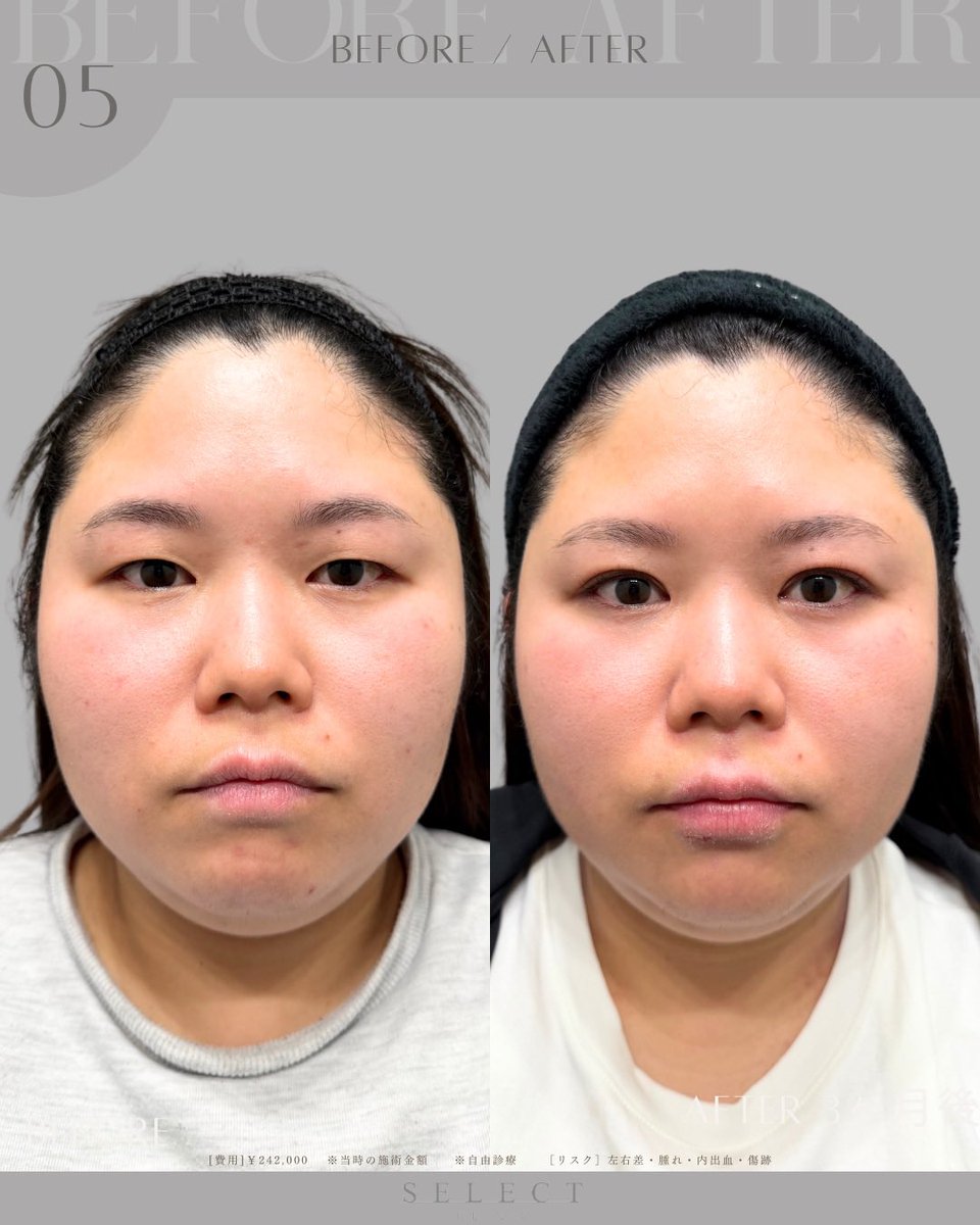 SELECTCLINIC's tweet photo. 【　自然な二重で、毎日のメイクがもっと楽しく🪞✨　】

執刀医　形成外科専門医 / 美容外科専門医
@dr_oiwa 

〈 症例紹介 〉

幅広の二重をご希望でご来院された患者様です💭

ご希望の幅は骨格上そのまま再現することが難しかったため、
解剖学的な視点から丁寧にご説明を行い、ご納得いただいた上で施術を行いました。

骨格に合わせながら、
できる限り自然に、そして最大限ぱっちりと見えるデザインをご提案✨

〈 施術内容 〉
・全切開
・腫れ止め点滴
・内服
・笑気麻酔

〈 患者様情報 〉
年代：30代前半女性
お悩み：全切開希望

セレクトクリニックでは、
患者様一人ひとりの骨格やまぶたの状態を丁寧に診察し、
理想だけでなく”似合うデザイン”まで考えた施術をご提案しています✨

美容外科が初めての方や、
手術に不安を感じている方にも安心してお任せいただけるよう、
カウンセリングからアフターフォローまで丁寧にサポートいたします💭🌿

「自分に似合う二重がわからない」
「埋没と切開で悩んでいる」

そんな方もお気軽にご相談くださいませ🕊️✨