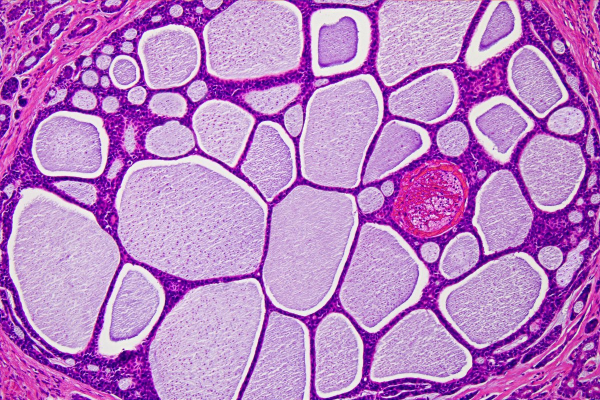 Patholwalker's tweet photo. Adenoid cystic carcinoma of submandibular gland. HE, Alcian-Blue and PAS. #Pathology #Pathologist #ENTPath https://t.co/1N1N2j6eOu