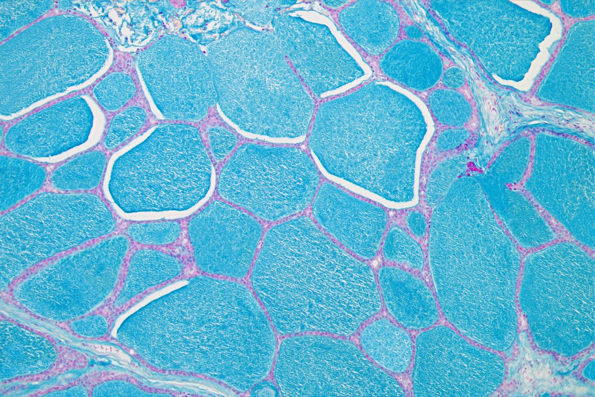 Patholwalker's tweet photo. Adenoid cystic carcinoma of submandibular gland. HE, Alcian-Blue and PAS. #Pathology #Pathologist #ENTPath https://t.co/1N1N2j6eOu