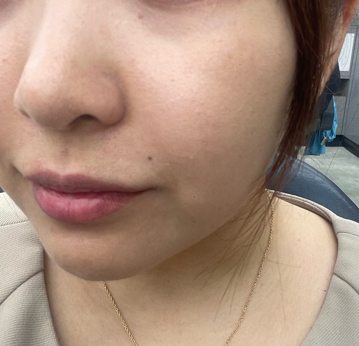 YuiChama_U's tweet photo. 2週間後🤍
お肌ツルツル！ ノーマルカメラでこれです！ここでボトックスもうけたけど、先生めっちゃ上手✨
眉間とかおでこ打つと目重くなりがちだけどならない！まじですごい✨️
これから顔のボトックスはここで打とう😌💖 https://t.co/NGFSbAbEnM