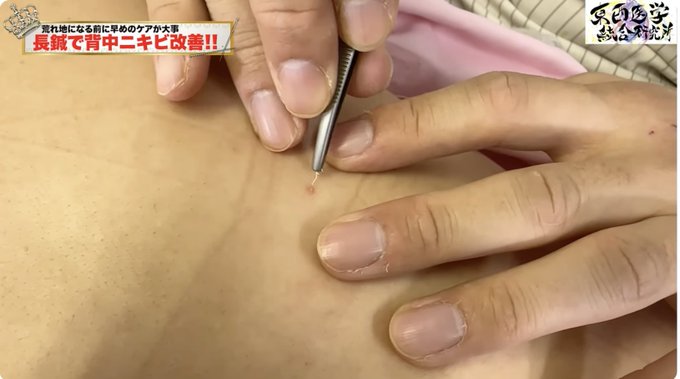 biyohari's tweet photo. ニキビを改善してもまた出てくるその原因は？

【ニキビ　角栓粉瘤】ニキビ角栓鍼治療　20年来の背中ニキビは鍼灸治療で改善するのか？【鍼灸院ブレア銀座虎ノ門・元町　東西医学統合研究所】 https://t.co/w3tTTBTDwL @YouTubeより https://t.co/s28yYetCu3