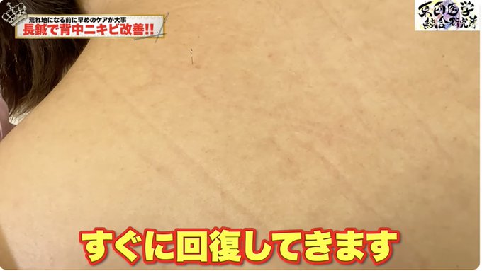 biyohari's tweet photo. ニキビを改善してもまた出てくるその原因は？

【ニキビ　角栓粉瘤】ニキビ角栓鍼治療　20年来の背中ニキビは鍼灸治療で改善するのか？【鍼灸院ブレア銀座虎ノ門・元町　東西医学統合研究所】 https://t.co/w3tTTBTDwL @YouTubeより https://t.co/s28yYetCu3