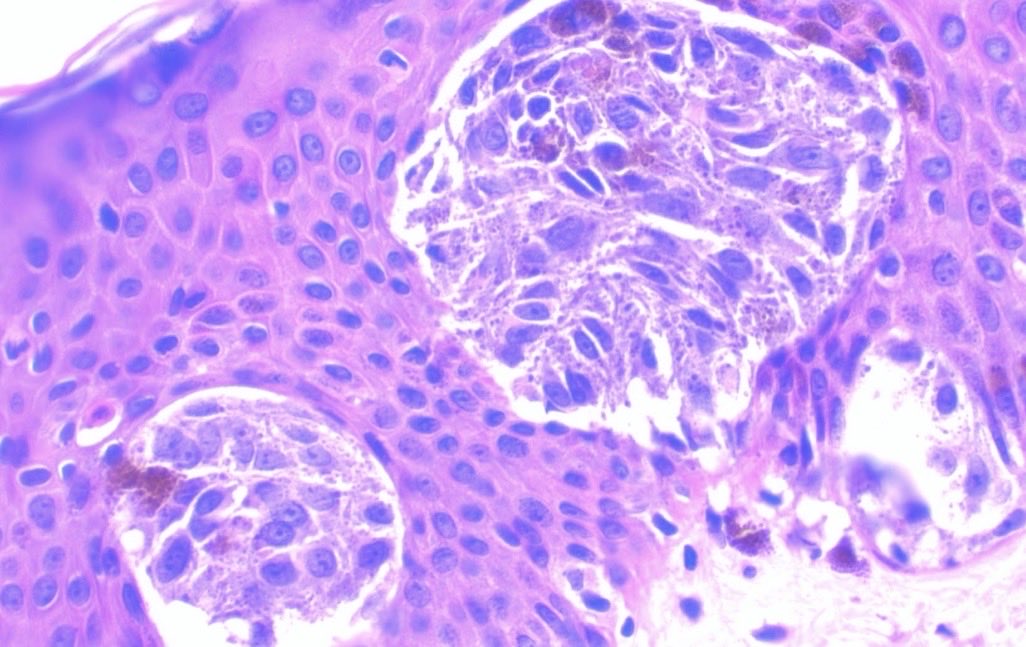 JCandidoXavier's tweet photo. Pigmented Spitz nevus / Reed nevus

Adnexal involvement can also be observed in benign melanocytic lesions.

#pathology #path #dermatology #dermpath #medicine https://t.co/VIgr6RfOCF