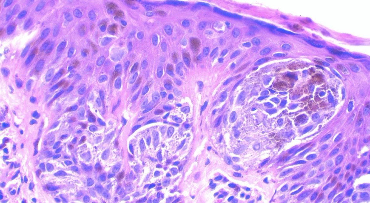 JCandidoXavier's tweet photo. Pigmented Spitz nevus / Reed nevus

Adnexal involvement can also be observed in benign melanocytic lesions.

#pathology #path #dermatology #dermpath #medicine https://t.co/VIgr6RfOCF