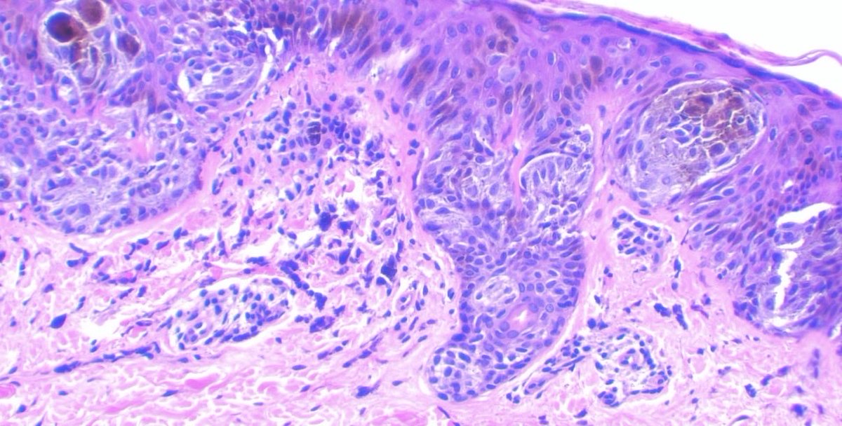 JCandidoXavier's tweet photo. Pigmented Spitz nevus / Reed nevus

Adnexal involvement can also be observed in benign melanocytic lesions.

#pathology #path #dermatology #dermpath #medicine https://t.co/VIgr6RfOCF