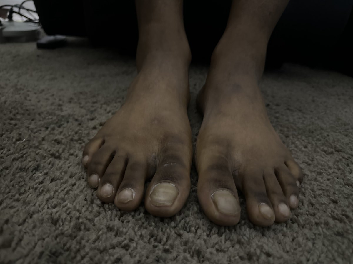 TheManCaveMS's tweet photo. Follow and support the IG @mancavemalesalon

#pedicure #feet #mancave #mancavellc #mancaveexperience #uglyfeet #manfeet #prettyfeet #manicure #fyp #nailart #blackmanfeet #blackman #ebonyfeet #toes #soles #BlackOwned #foot #nails #blackmalefeet #blackmale #fyp #pov https://t.co/PnuFTV0XQR